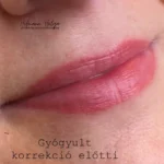 gyógyul száj korrekció előtt