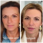 gyógyult szemöldök és gyógyult száj