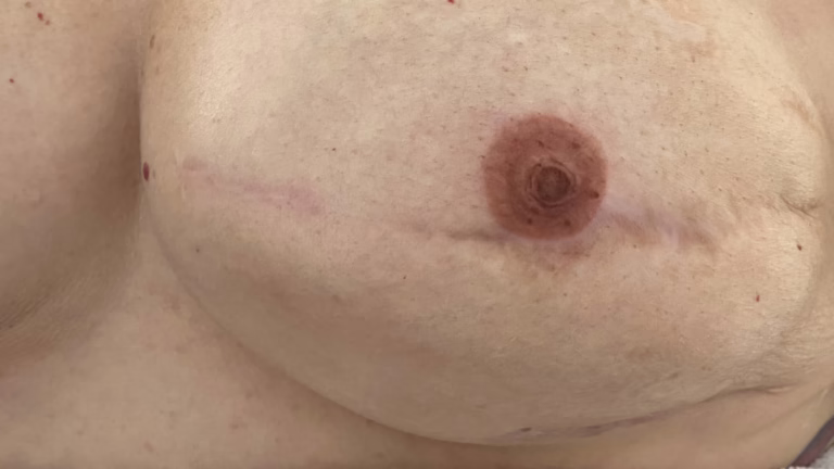 areola tetoválás